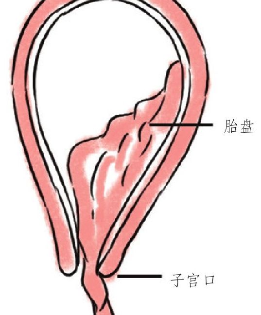第三产程——胎盘娩出期|胎盘|产程|子宫_新浪新闻