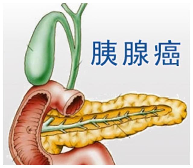 女子腰疼3个月,体检时发现体内长了肿瘤,这是为什么呢?休闲区蓝鸢梦想 - Www.slyday.coM 女子腰疼3个月,体检时发现体内长了肿瘤,这是为什么呢?休闲区蓝鸢梦想 - Www.slyday.coM