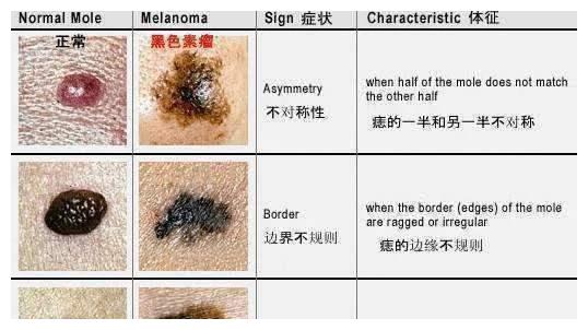 孩子有胎记就是被天使吻过这几种胎记家长可千万不能大意