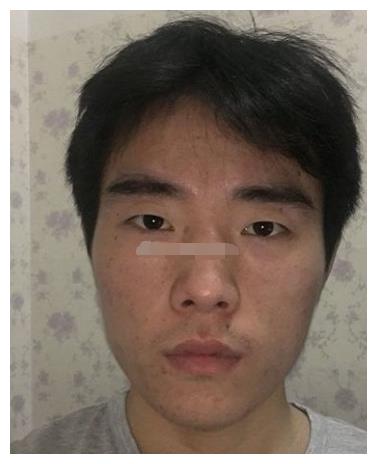 鼻翼有痣事业财运不好且子女的缘分浅薄