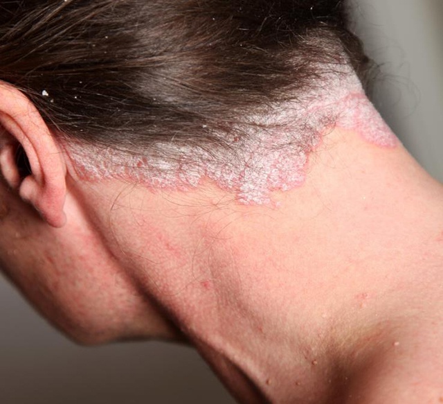 皮小度带你正确了解银屑病科学认知尤为重要可防可治