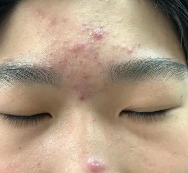 10岁就长"痘痘"?快来了解下儿童痤疮