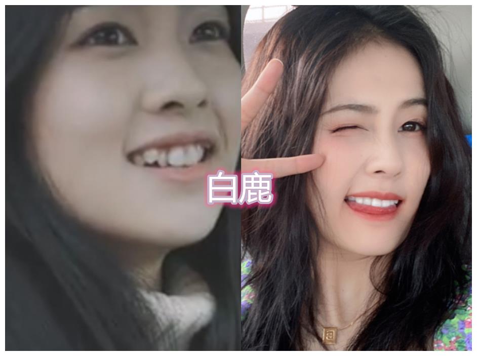 整牙前vs整牙后白鹿变化不大看到林心如漂亮依旧