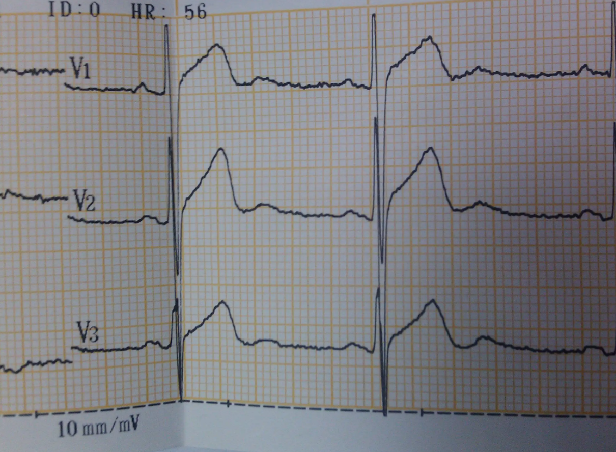 我们应该重视入职体检心电图检查,做好相应的准备和操作,以便顺利通过