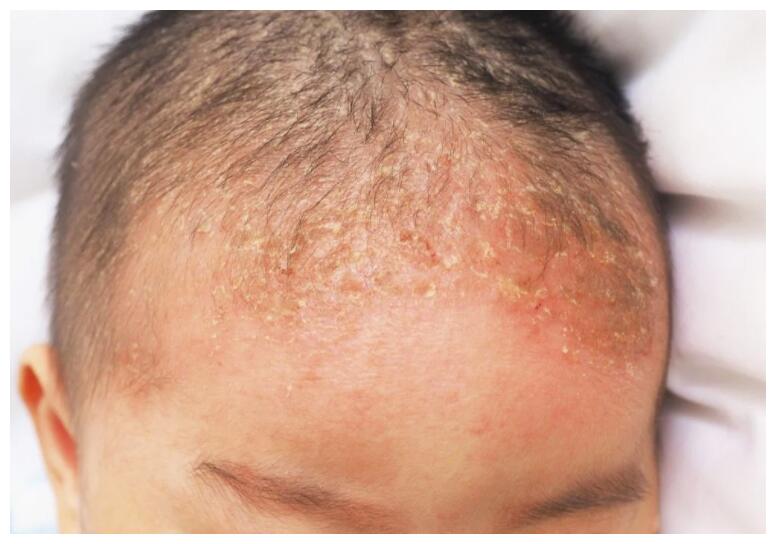 医生:宝宝长头泥,另有他因|宝宝|头皮|医生_新浪新闻