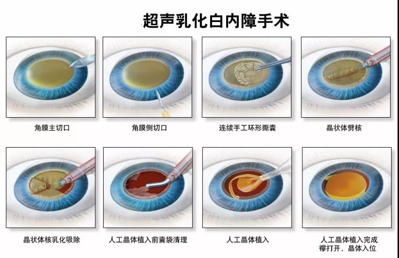 0305的视力为什么是白内障手术的最佳时机