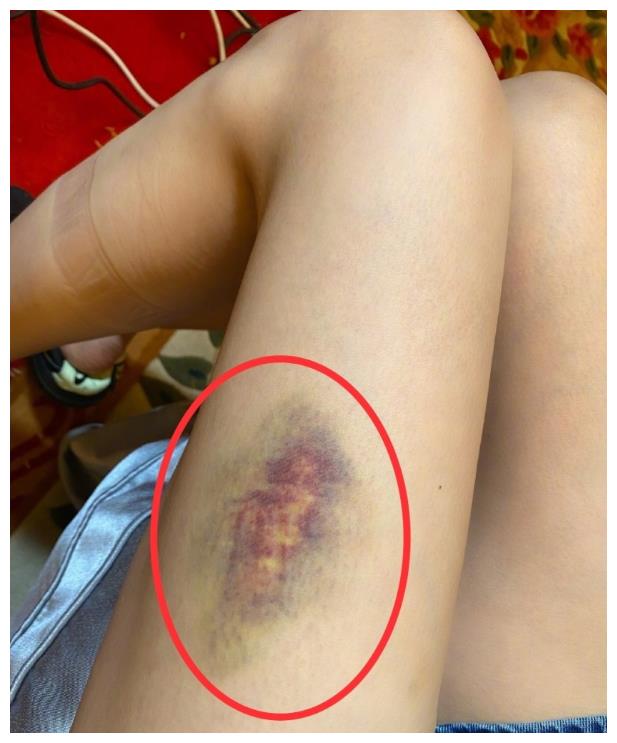 沈梦辰晒大腿受伤照第一个跑来关心的不是杜海涛两人吵架了