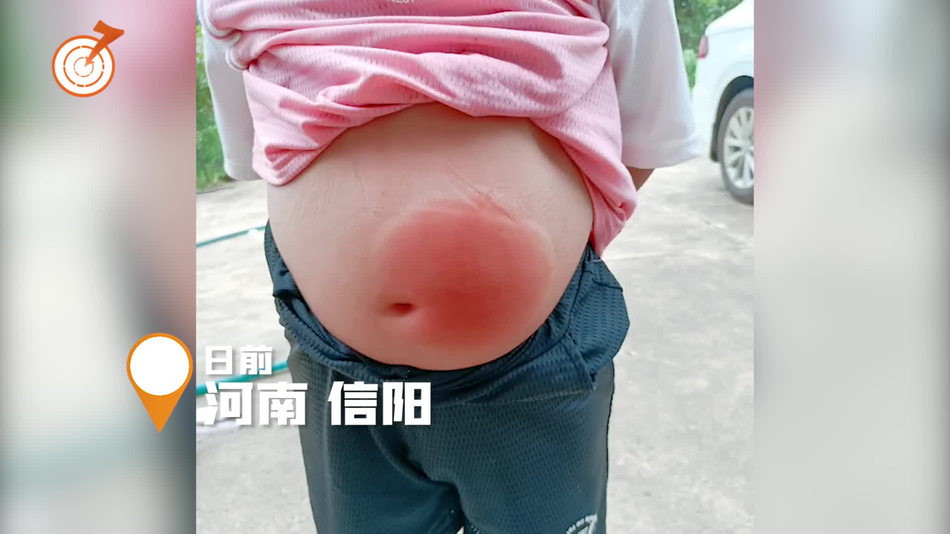 小男孩肚子被蚊子叮起大疙瘩,因肚子圆鼓鼓被认成孕妇!