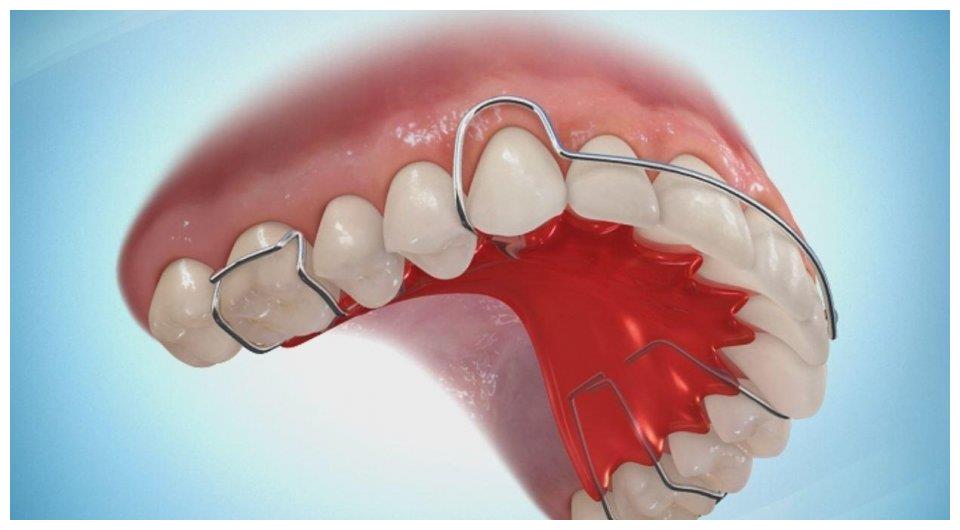 做完矫正为什么还要戴保持器保持器要戴多久