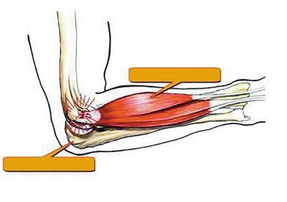 40岁最常见的网球肘,不打网球也会得!防治与康复都需要