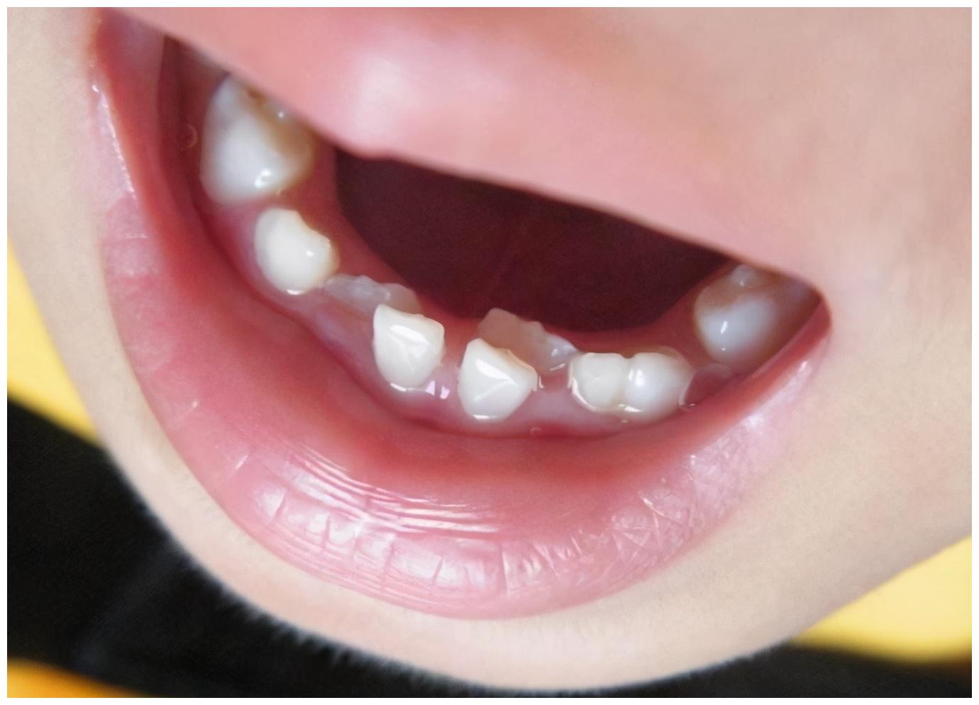 6岁孩子满口"黑牙",罪魁祸首不是吃糖,而是父母的疏忽造成的