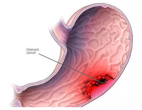 感染幽门螺杆菌或诱发胃癌,共餐时易致全家感染休闲区蓝鸢梦想 - Www.slyday.coM 感染幽门螺杆菌或诱发胃癌,共餐时易致全家感染休闲区蓝鸢梦想 - Www.slyday.coM