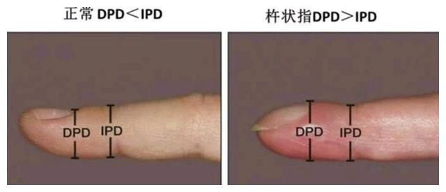 警惕,手指出现杵状指,或是心脏病的征兆|杵状指|溃疡性结肠炎|肺癌_新浪新闻
