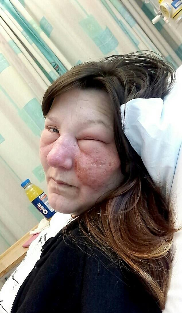 ""这个女的,刚开始在鼻子里面烂了一个小口.