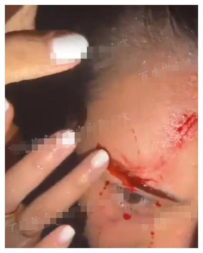 继阿娇之后,又一名女演员头部受伤,鲜血从眼角流到嘴边触目惊心