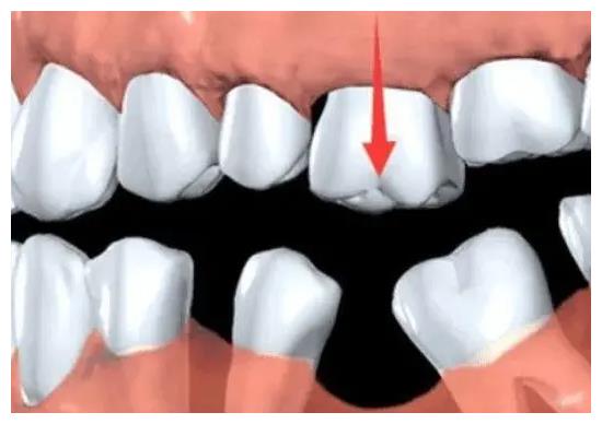 缺牙没有及时修复的老年人这五大危害都经历过吗