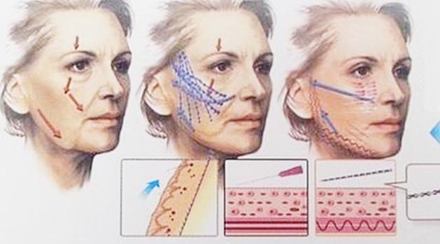 分析:做线雕的最佳年龄是多少?做完线雕脸上有凹陷多久会恢复?休闲区蓝鸢梦想 - Www.slyday.coM 分析:做线雕的最佳年龄是多少?做完线雕脸上有凹陷多久会恢复?休闲区蓝鸢梦想 - Www.slyday.coM
