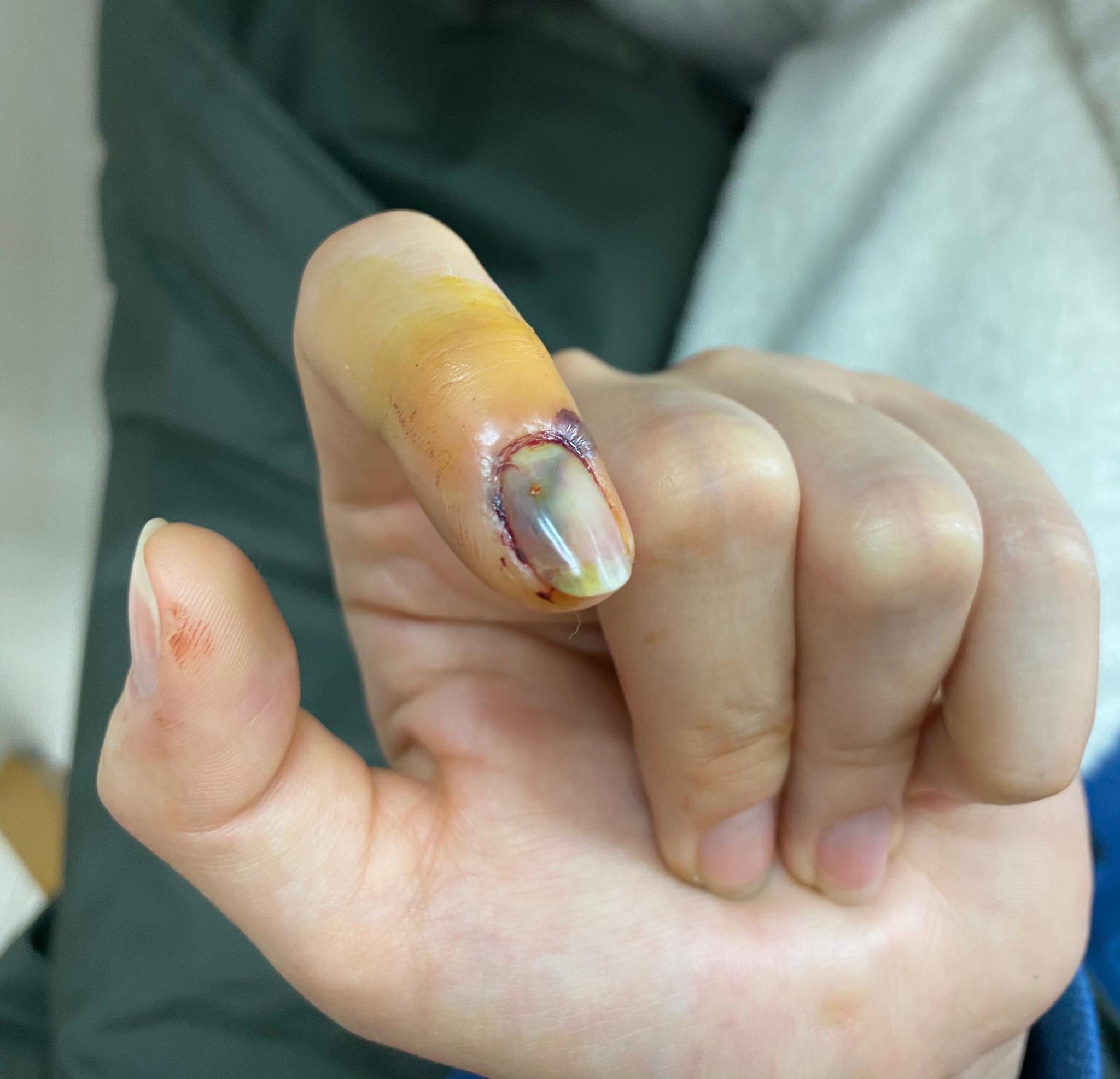 宋祖儿手被门夹在线痛哭 网友们纷纷心疼安慰