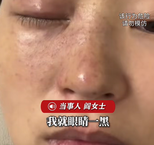 长沙一女子树下接板栗，被坠落的带刺板栗直接砸中眼睛