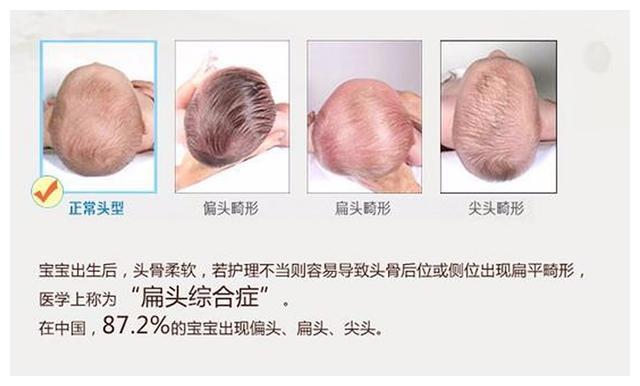 新生儿头型睡扁不要慌,改善扁头有三招,"正确睡姿"爸妈要知道|宝宝