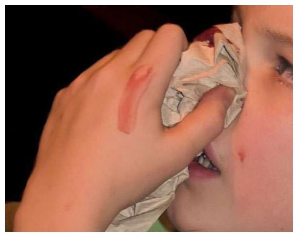 女儿突然流鼻血,妈妈让仰头,结果孩子送医院,医生:幸亏送及时