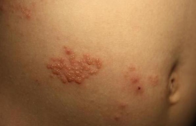 "生蛇"不可怕,可怕的是神经痛|带状疱疹|神经痛|皮损_新浪新闻