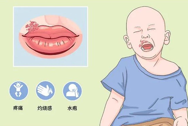 对于复发性单纯疱疹口服抗病毒药可以减轻症状,缩短病程.