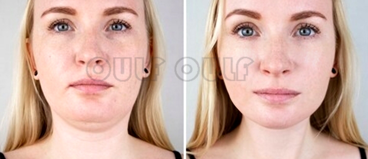 分析:做线雕的最佳年龄是多少?做完线雕脸上有凹陷多久会恢复?休闲区蓝鸢梦想 - Www.slyday.coM 分析:做线雕的最佳年龄是多少?做完线雕脸上有凹陷多久会恢复?休闲区蓝鸢梦想 - Www.slyday.coM