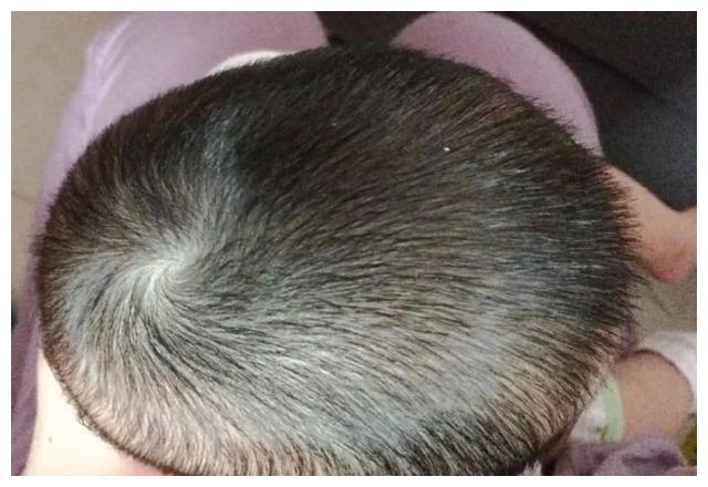 并不是所有奇怪的头型都是正常的,像舟状头,三角头等头部变形的特别