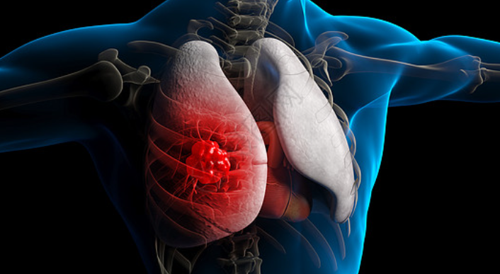 不抽烟不喝酒的女性,怎么也会得肺癌?休闲区蓝鸢梦想 - Www.slyday.coM 不抽烟不喝酒的女性,怎么也会得肺癌?休闲区蓝鸢梦想 - Www.slyday.coM