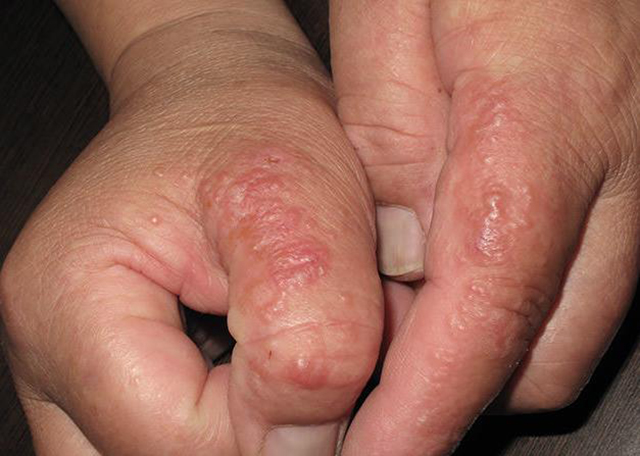 汗疱疹会不会传染带你正确认识汗疱疹