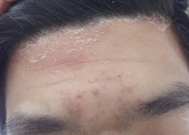 脂溢性皮炎脸部图片(面部脂溢性皮炎的症状图片)