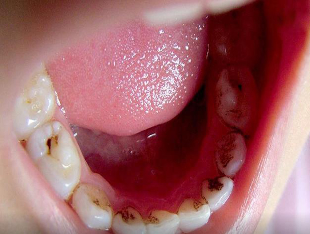 天天刷牙依然有口臭,出现这种臭味别大意|扁桃体结石|扁桃体|刷牙