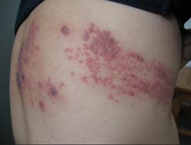 "生蛇"不可怕,可怕的是神经痛