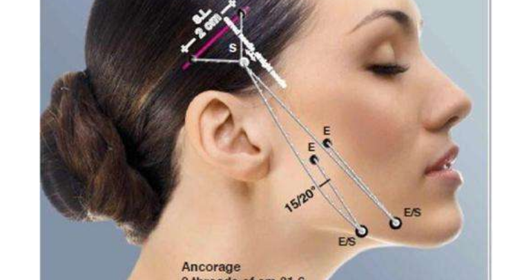 分析:做线雕的最佳年龄是多少?做完线雕脸上有凹陷多久会恢复?休闲区蓝鸢梦想 - Www.slyday.coM 分析:做线雕的最佳年龄是多少?做完线雕脸上有凹陷多久会恢复?休闲区蓝鸢梦想 - Www.slyday.coM