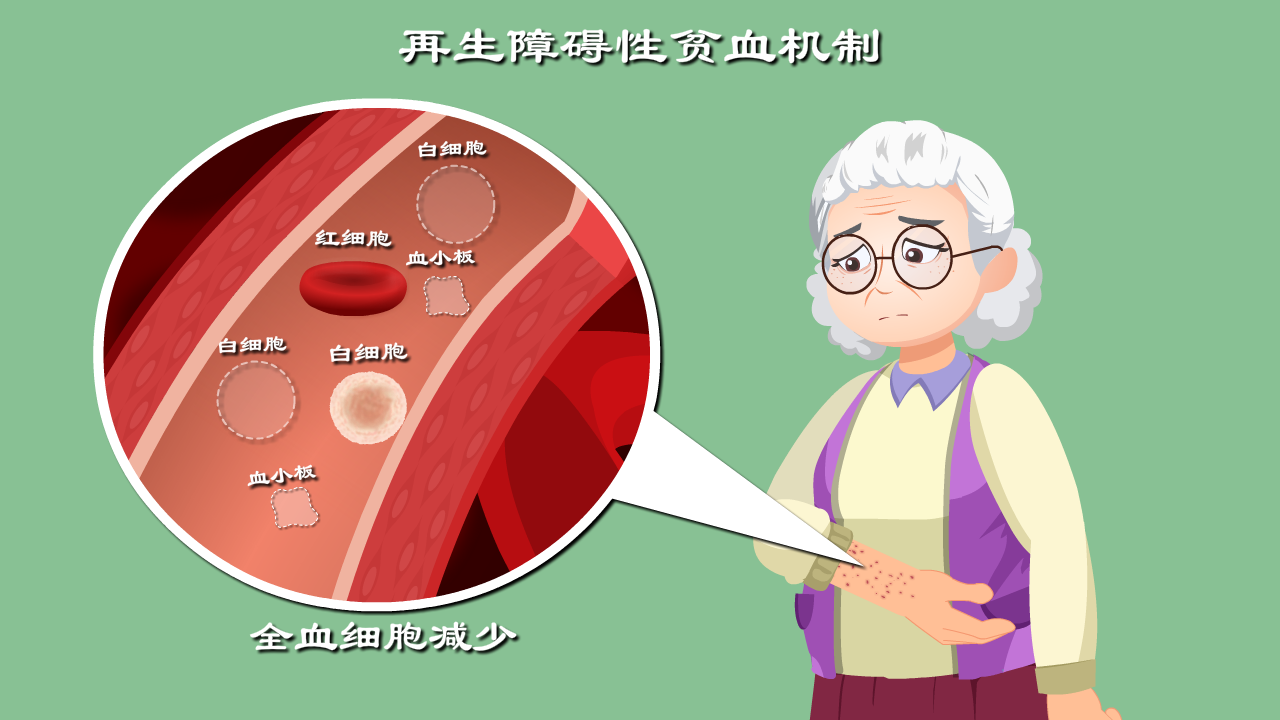 导致贫血出血不止全身感染的恐怖疾病解密再生障碍性贫血
