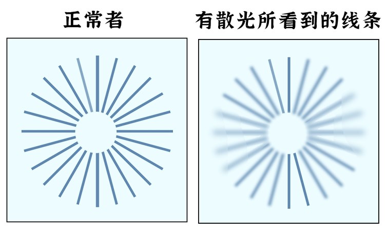 几乎每个人都或多或少有散光100°以内的散光很常见但散光超过100°后