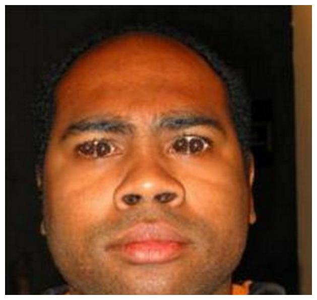 拥有双瞳孔的人,他们看到的世界,和我们有什么不一样|瞳孔|o型|正常人