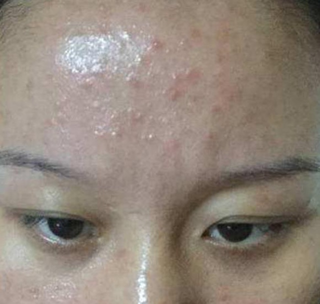 盐,皮肤过于的干燥,就会分泌油脂来保护皮肤,进而看起来很油腻因此