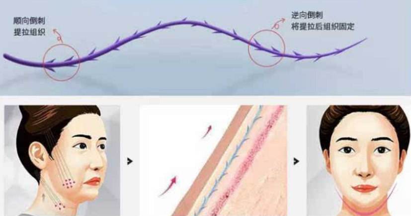 分析:做线雕的最佳年龄是多少?做完线雕脸上有凹陷多久会恢复?休闲区蓝鸢梦想 - Www.slyday.coM 分析:做线雕的最佳年龄是多少?做完线雕脸上有凹陷多久会恢复?休闲区蓝鸢梦想 - Www.slyday.coM