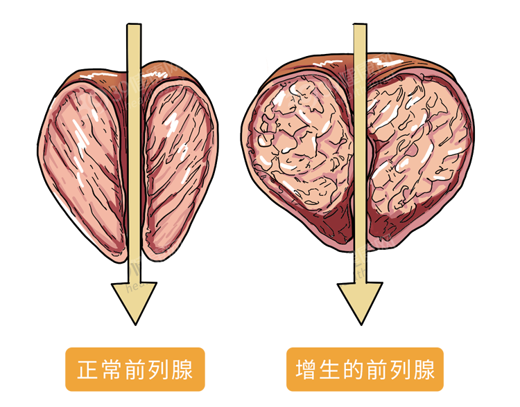 提醒男性30岁后想要远离前列腺增生这3个行为要少做