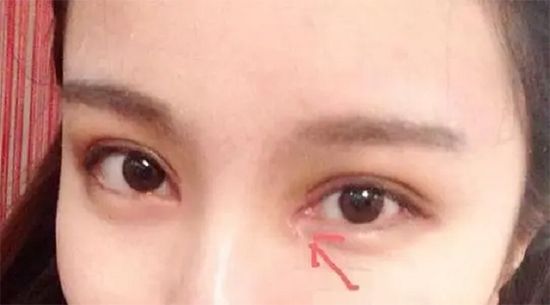 内眼角开太大了怎么办修复内眼角眼睛会不会变小