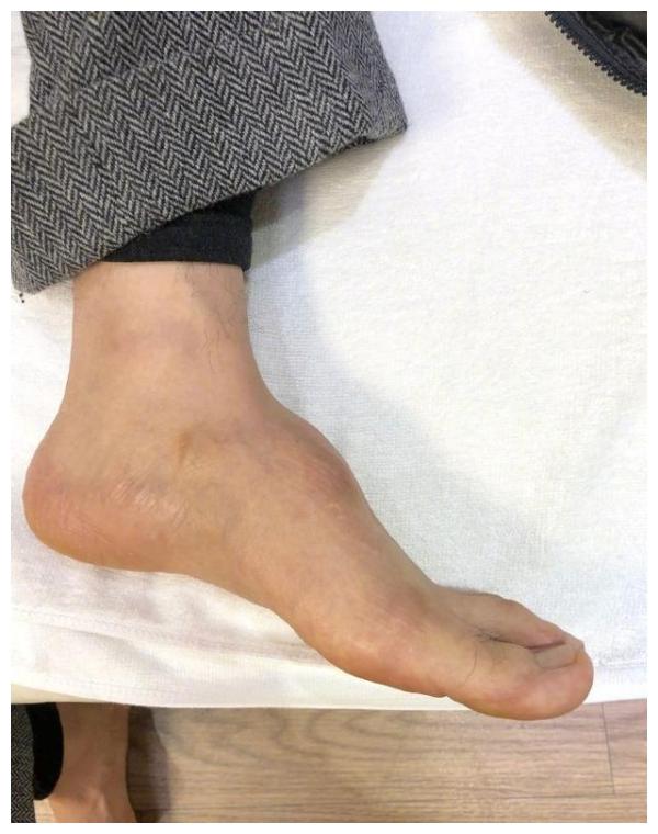 黄晓明自曝拍戏骨折留下后遗症,左脚打钢钉仅40天就复工太拼命