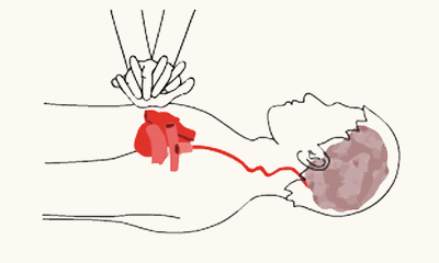 心肺仪是什么心肺复苏——对“时间就是生命”最好的诠释！_https://www.jmylbn.com_新闻资讯_第6张