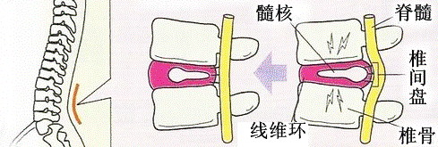 麦肯基疗法关于维持正确姿势