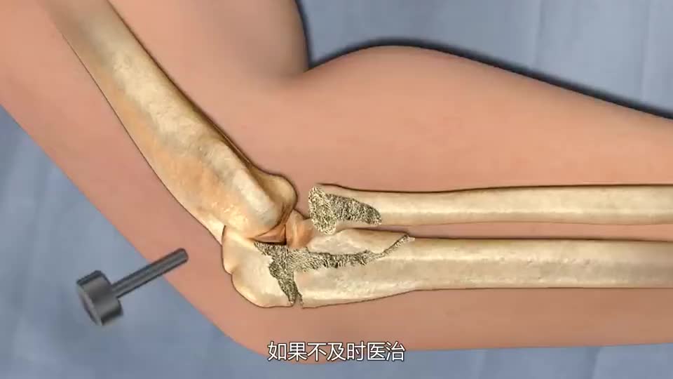骨折后自然恢复的骨头,会不会长歪?看完3d动画演示涨知识了!