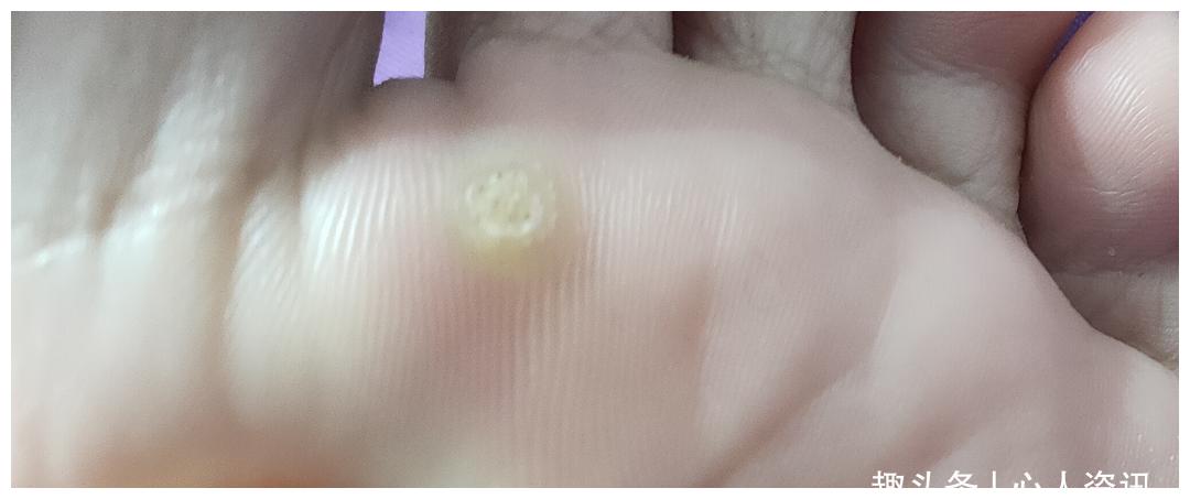 鸡眼图片初期症状鸡眼怎么引起的