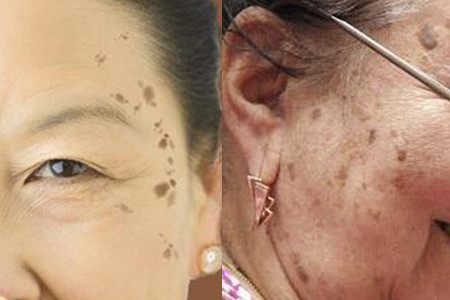 手上长了老年斑怎么办（手上长老年斑应该怎么办）-85模板网