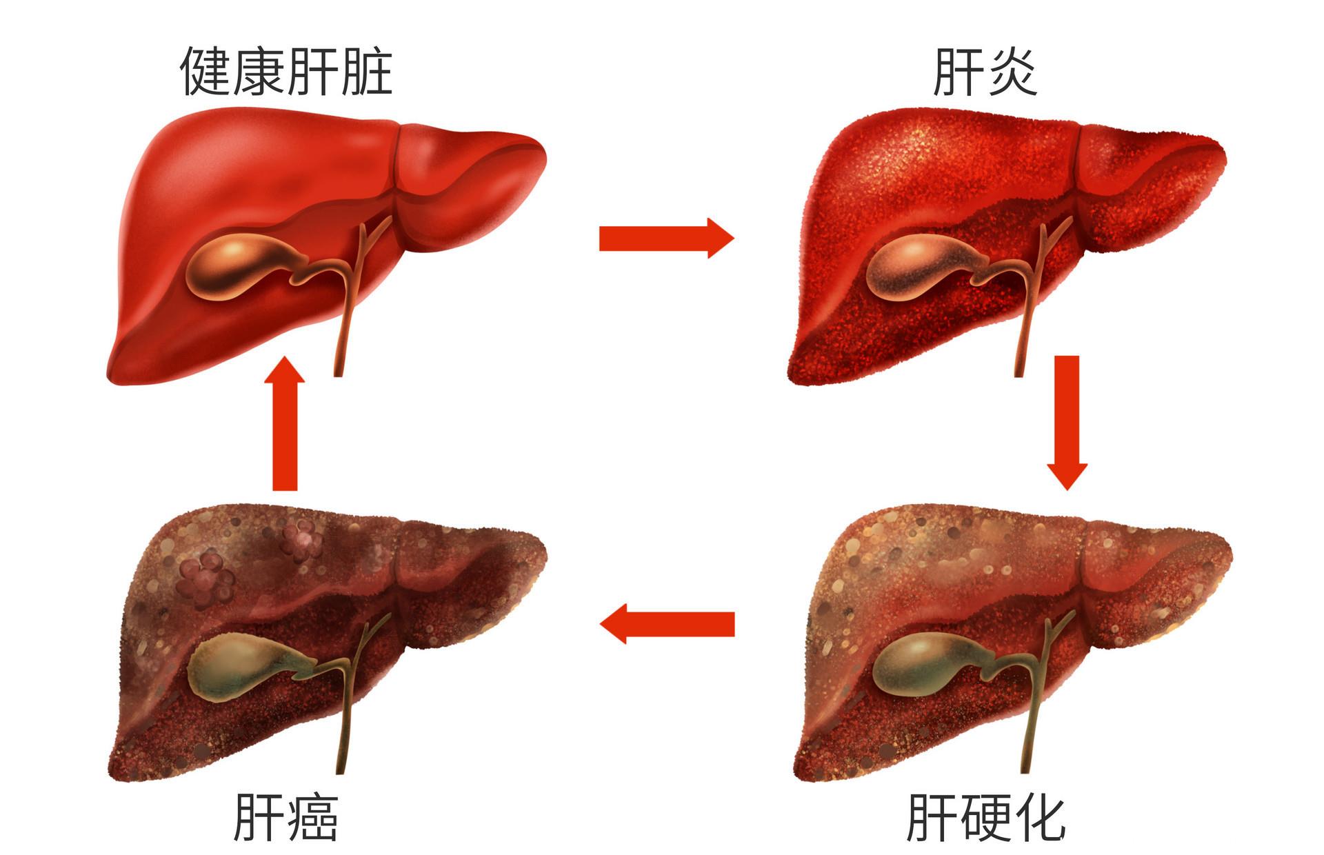 著名音乐人赵英俊因肝癌去世,肝脏若有四个特征,提示该体检了