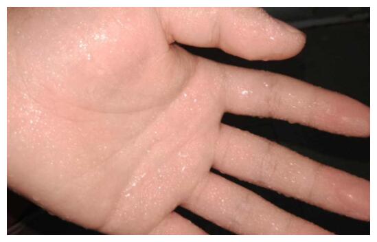 手心容易出汗是怎么回事,手心容易出汗是什么原因|手心|症状|交感